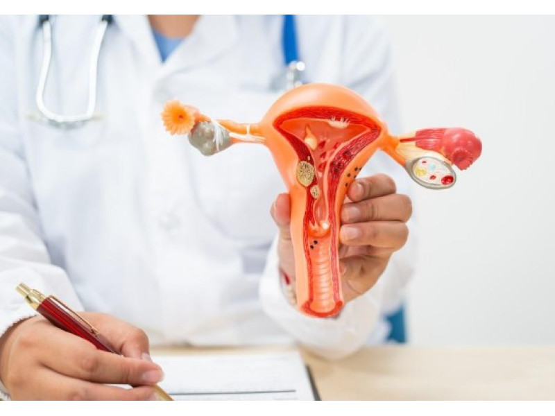 Миома матки: причины, симптомы и методы лечения