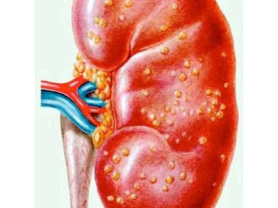 Хронический пиелонефрит: симптомы, лечение и профилактика