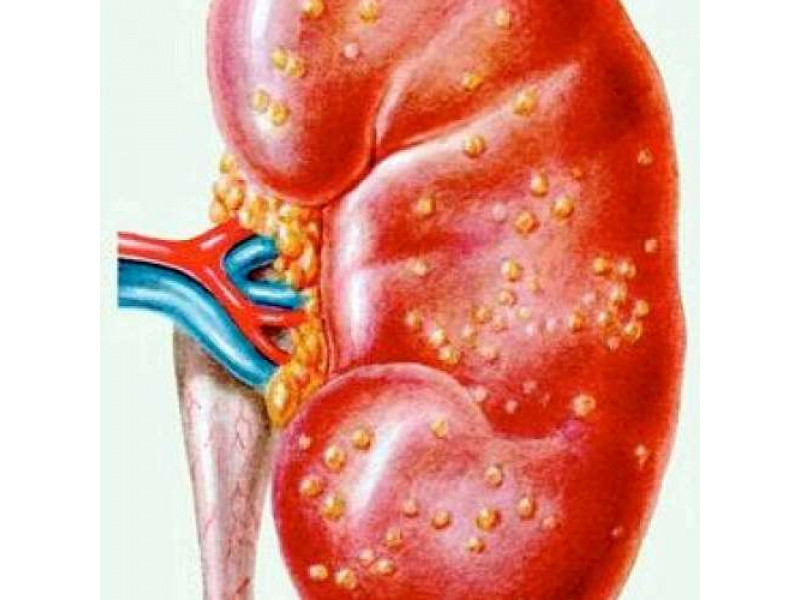 Хронический пиелонефрит: симптомы, лечение и профилактика