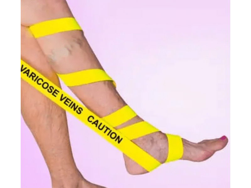 Хроническая венозная недостаточность