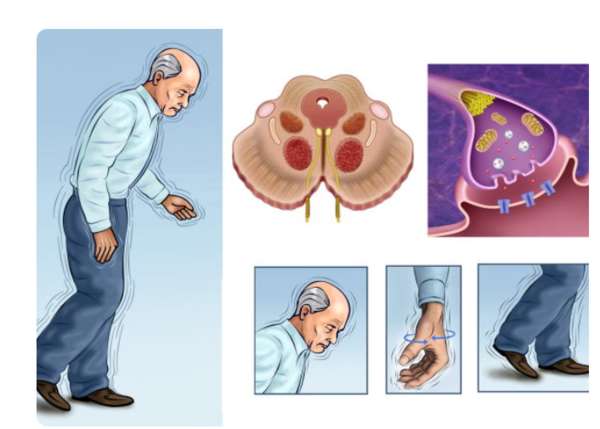 Фото болезнь паркинсона